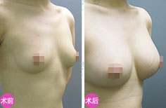 假体隆胸案例手术效果前后对比图